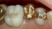 Zahnersatz aus Edelmetall